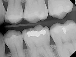 Digital X-ray of teeth