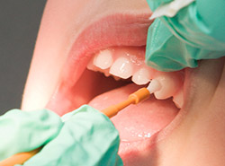 Dentist applying a fluoride treatment on a patient's teeth