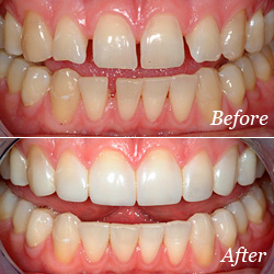 Photo of dental bonding before and after