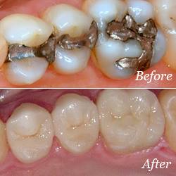 Photo of the teeth before and after dental filling