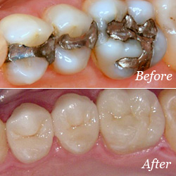 Dental Crowns Oak Park MI