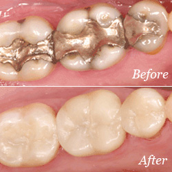 Photo of Dental Crowns Before and After