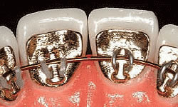 Lingual braces