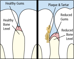 periodontal disease