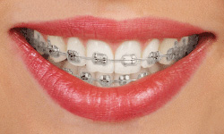 Braces: Orthodontics Farmington Hills MI - Pesis Family Dental - traditional-metal