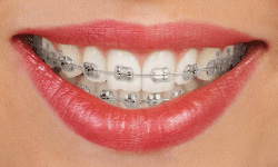 Traditional metal braces 